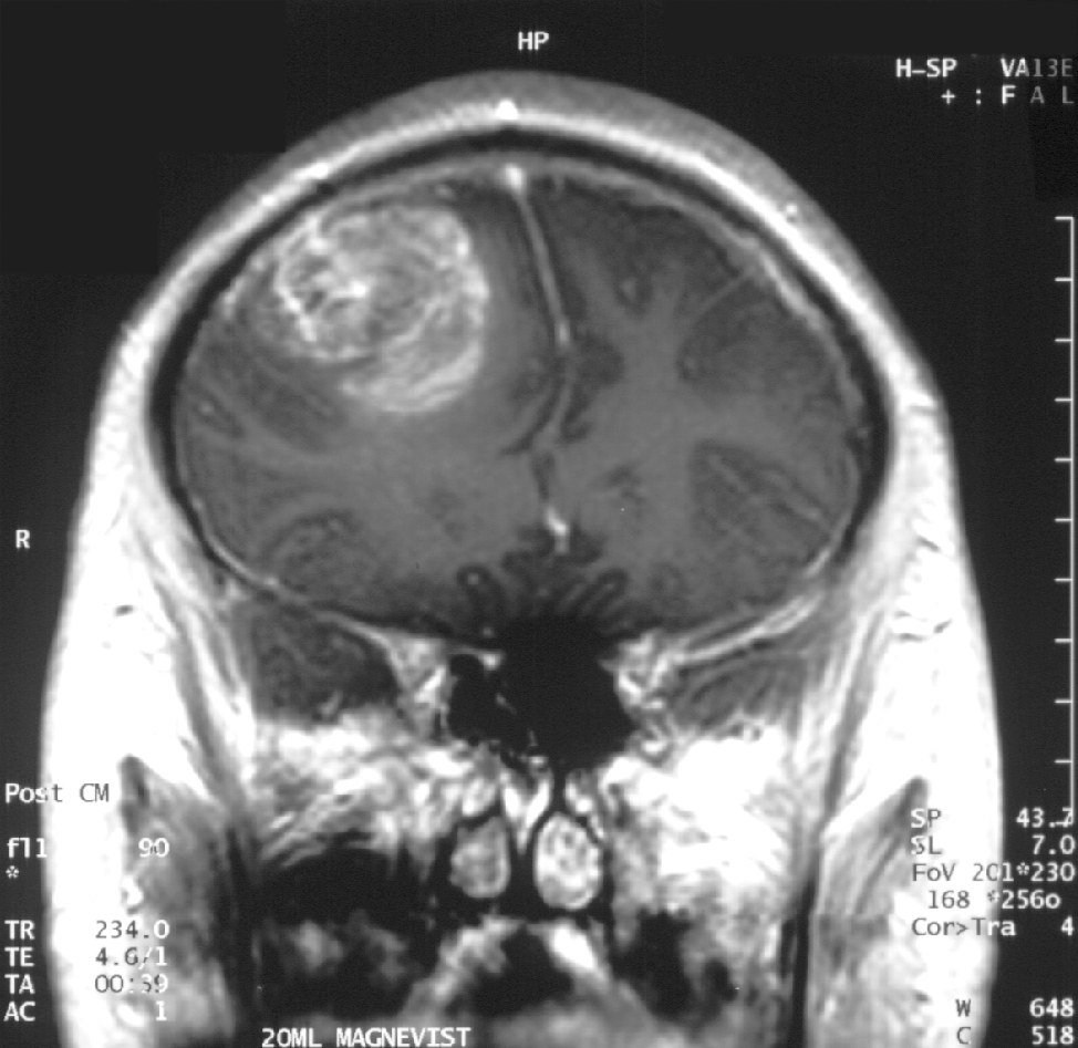Brain cancer