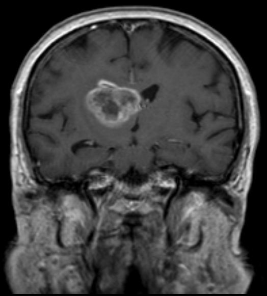 Glioblastoma multiforme - MRT T1KM cor