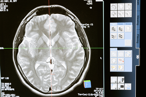 Delivery of cytostats intracranially